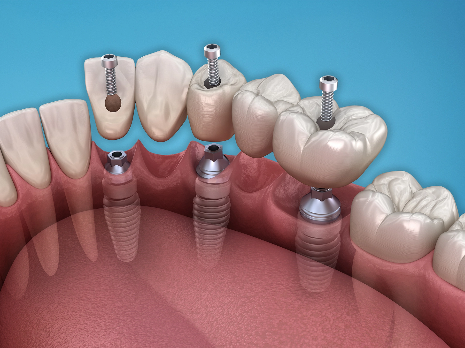 Implantologie Implantate Zahnimplantat Zahnarzt Rödermark