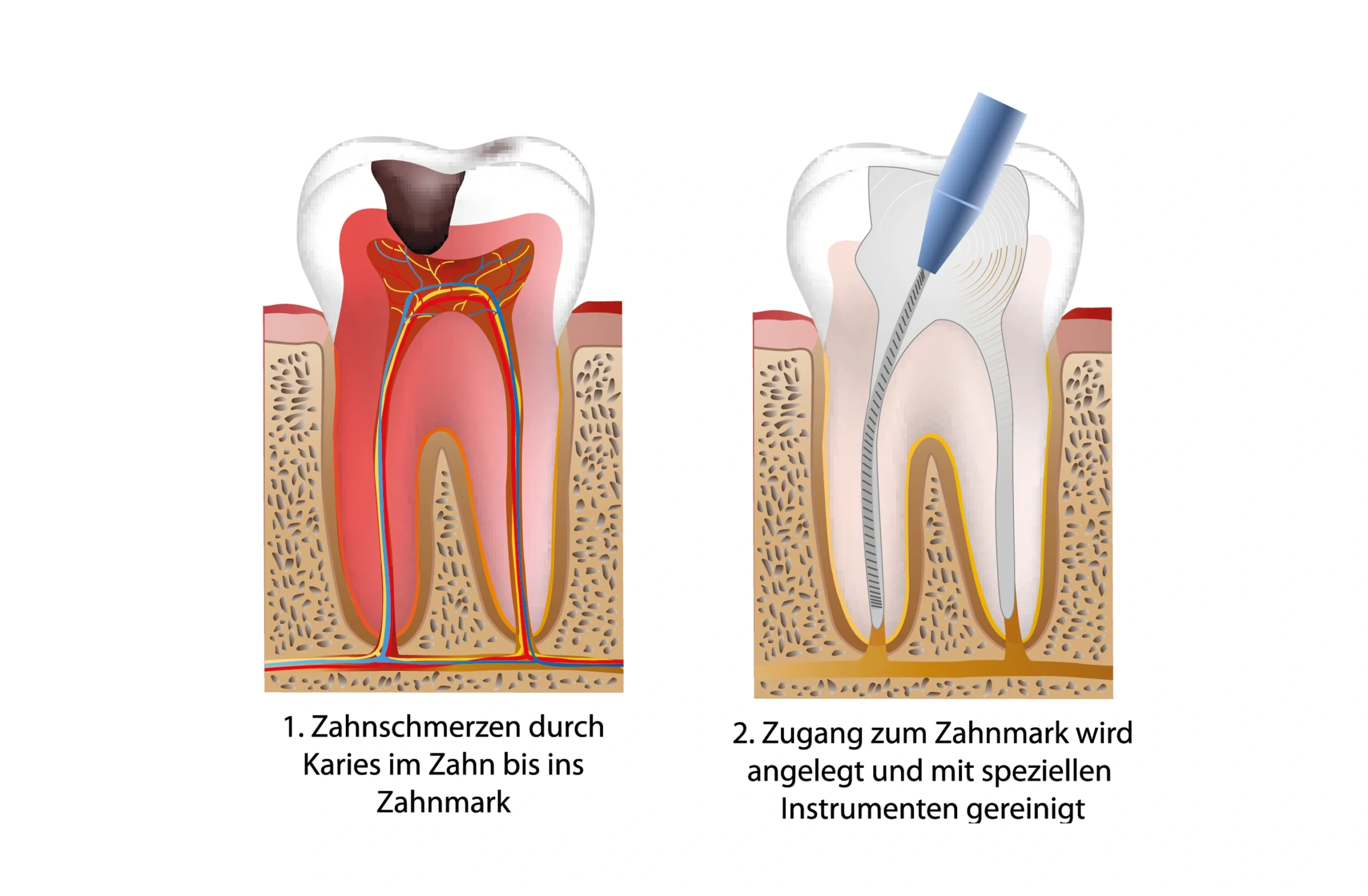 Ablauf Wurzelbehandlung Zahnarzt Rödermark